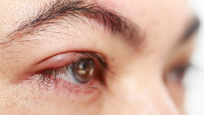  Why Does How To Get Rid Of a Stye - Stat!