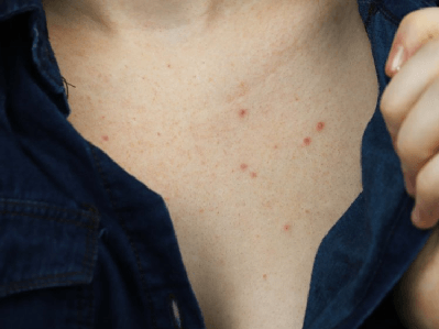 Why you're getting acne on your chest and what you can do to get rid of it