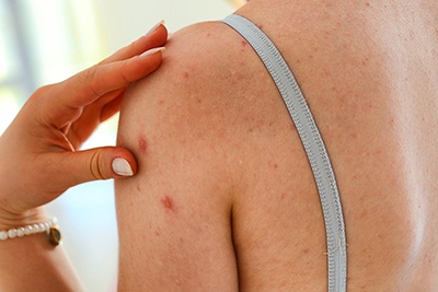11 skin bumps that look like pimples but aren’t