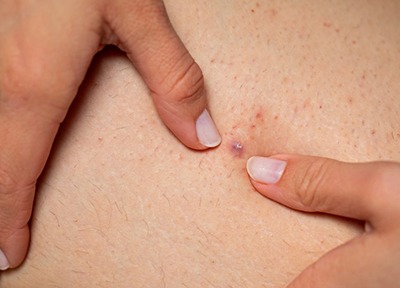 It’s easy to mistake folliculitis for body acne