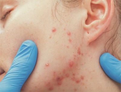 16 things to know before starting an acne treatment
