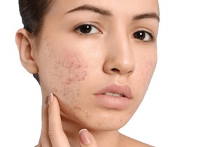 Are you breaking out? These surprisingly simple reasons could be why you have adult acne