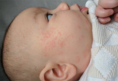 How Often Should You Bathe A Baby With Eczema? Experts Break It Down