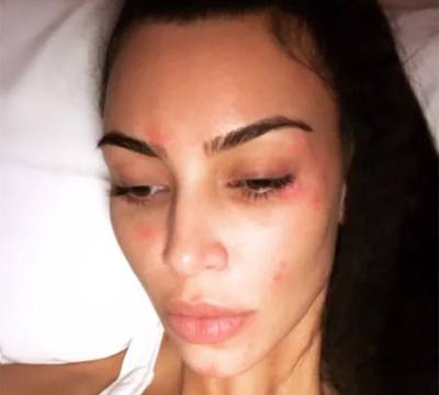 Everything Kim Kardashian Uses for Psoriasis That You Should (and Shouldn’t) Try, According to a Dermatologist