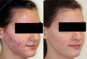 Acne Before & After Oral/Topical Medication