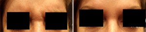 Image of Botox Frown Line Before and After