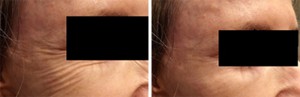 Image of Botox Crows Feet Before and After