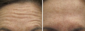 Image of Botox Forehead Before and After