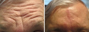 Image of Botox Forehead Before and After