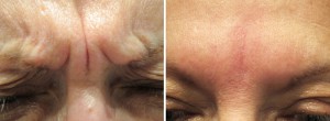 Image of Botox Frown Line Before and After