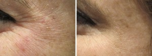 Image of Botox Crows Feet Before and After