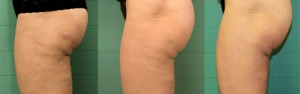 Before Leg & Buttocks & After Exilis Ultra