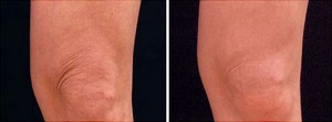 Before & After Exilis Ultra