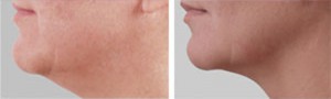 Before & After Exilis Ultra
