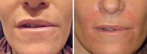 Image of Smile Lines Before and After Juvederm