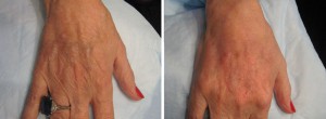 Image of Hands Before and After Radiesse