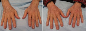 Image of Hands Before and After Radiesse