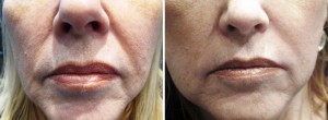 Image of Smile Lines Before and After Juvederm