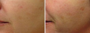 Before & After Genesis Laser Treatments