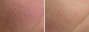 Before & After Genesis Laser Treatments