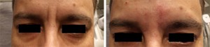 mage of Frown Line Before and After Juvederm