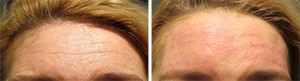 Image of Forehead Before and After Prevelle