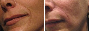 Image of Fine Lines Before and After Belotero