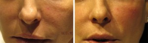 Image of Cheeks Before and After Juvederm Voluma