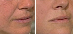 Image of Smile Lines / Marionette lines Before and After Juvederm