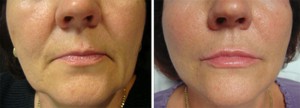 Image of Smile Lines / Marionette lines Before and After Juvederm