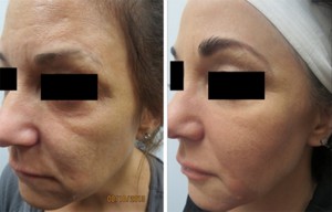 Image of Cheek Bones Before and After Juvederm Voluma