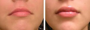 Image of Lip Augmentation Before and After Juvederm