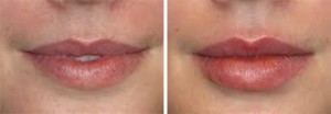 Image of Lip Augmentation Before and After Juvederm