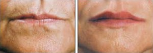 Image of Lip Augmentation and Vertical Lip Line Before and After Juvederm and Belotero