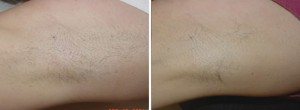 Before & After Laser Hair Removal