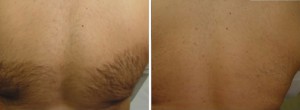 Before & After Laser Hair Removal