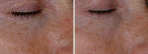 Before & After Laser Treatments