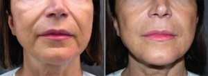 Before & After Thermage 1st Treatment