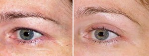 Before & After Eyes Thermage 1st Treatment