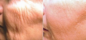 Before & After Thermage 2nd Treatment