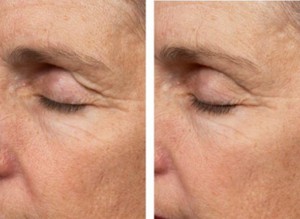 Before & After Eyes Thermage Treatment