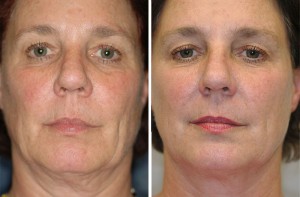 Before & After Thermage Treatment