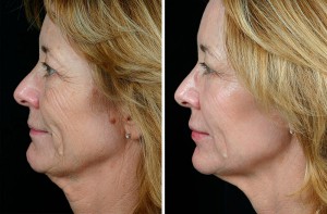Before & After Thermage Treatment