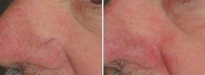 Before & After Laser Vein Treatment