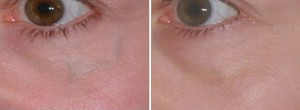 Before & After Laser Vein Treatment