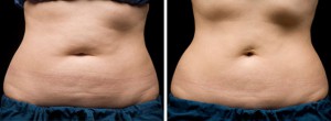 Before & After CoolSculpting