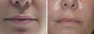 Before and After Filler Nasolabial Folds
