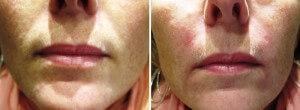 Before and After Nasolabial Folds Filler