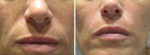 Filler for Nasolabial Folds Before and After