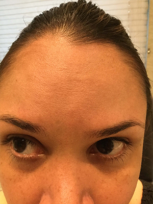 Botox Forehead Lines